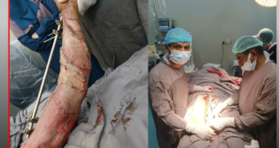 إنقاذ يد شاب من البتر في مستشفى الثورة بالحديدة